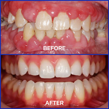 Official Store❤️Furzero™ Focussmile Bee Venom Treatment Oral Powder 🦷 (🇺🇸 FDA-Certified) (Treats periodontitis and mouth ulcers, prevents loose tooth & bleeding gums, and repairs gum recession)