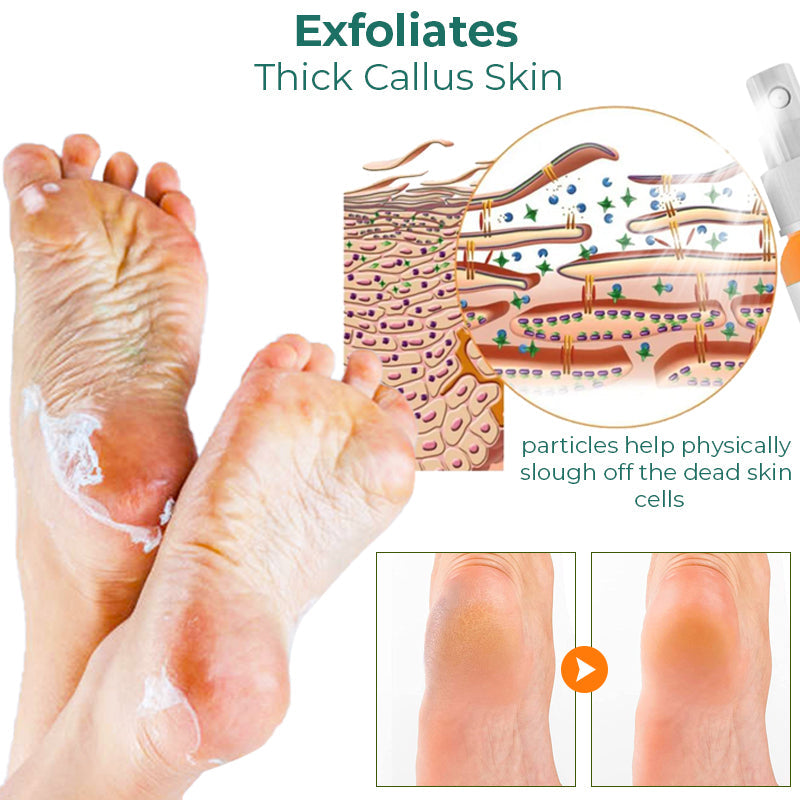 GFOUK™ Foot Callus Removal Spray