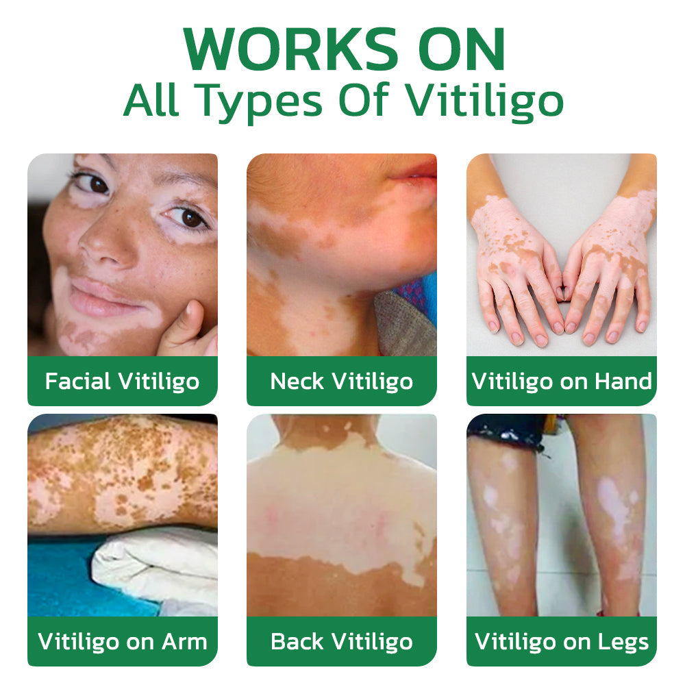 GFOUK™ TreatVitiligo Soothing Cream