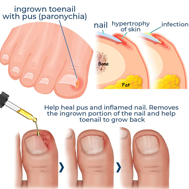 German ToenailPlus™ Anti Paronychia Relief Oil