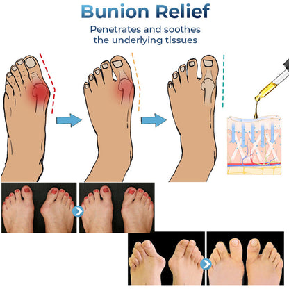 GFOUK™ German Bunion Relief Oil