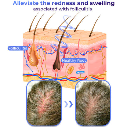 GFOUK™ Anti Folliculitis Therapy Oil